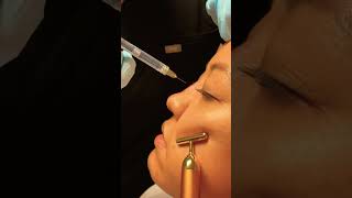 Non-Surgical Rhinoplasty with Stunning Results! By Plastic Surgeon, Dr. Seattle