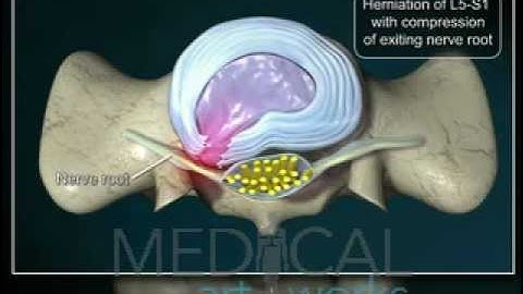 3D Medical Animation | L5-S1-paracentral-disc-herniation with compression of nerve root