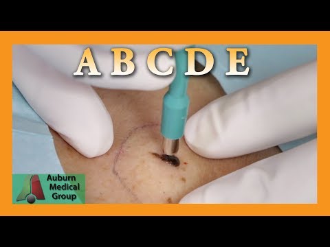 Biopsy ABCDE | Auburn Medical Group