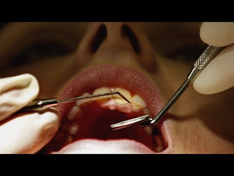 Video: ¿Los dentistas arreglan los dientes astillados?