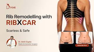 RIBX Scarless Rib Remodeling | Slim Waist Without Rib Removal | Dr Amit Gupta