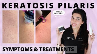 Keratosis Pilaris: Causes, Symptoms & Treatments from a Dermatologist #keratosispilaris #chickenskin