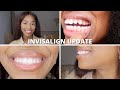 7 MONTH INVISALIGN UPDATE | INVISALIGN BEFORE AND AFTER