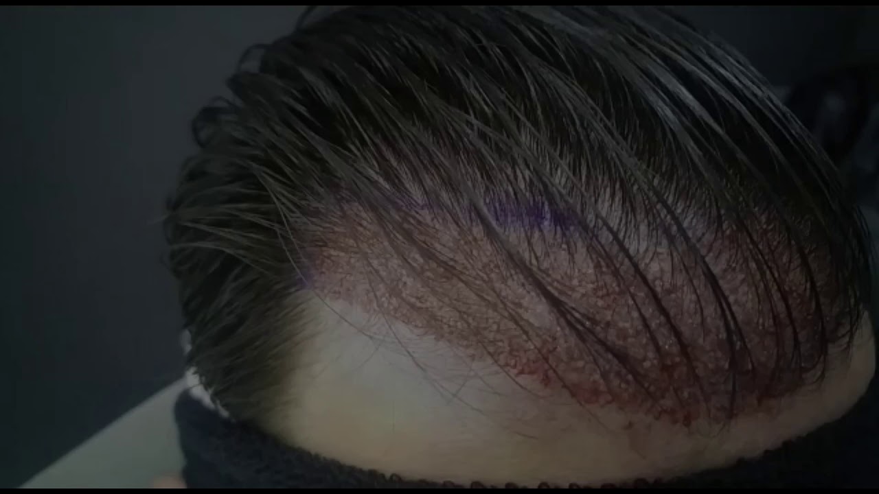 Without Shave Operation with DHI Technique