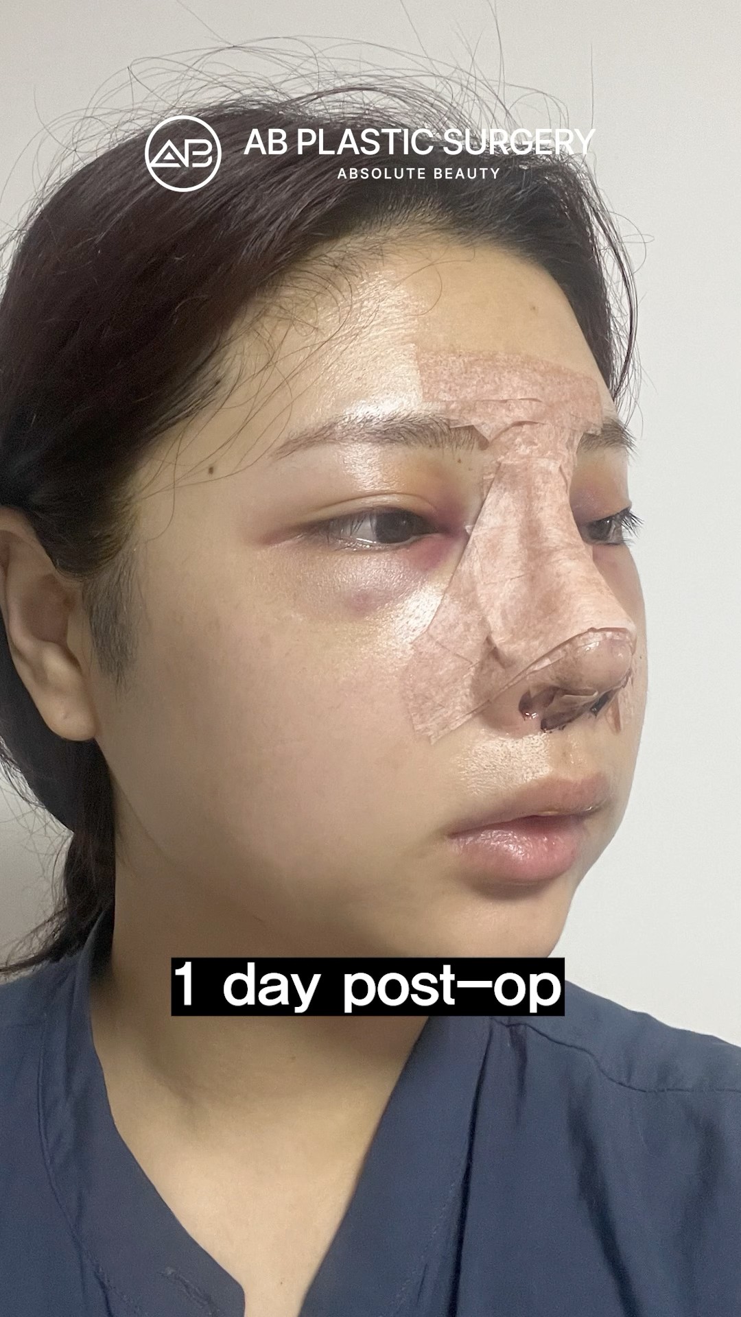 Having one Rhinoplasty changed my life #koreanplasticsurgery