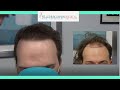 Young Hair Transplant Patients Must Watch! | Hair Transplant Results | Feller & Bloxham | NY, NYC
