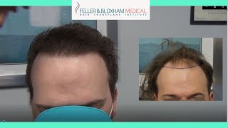 Young Hair Transplant Patients Must Watch Hair Transplant Results Feller Bloxham Ny Nyc Youtube