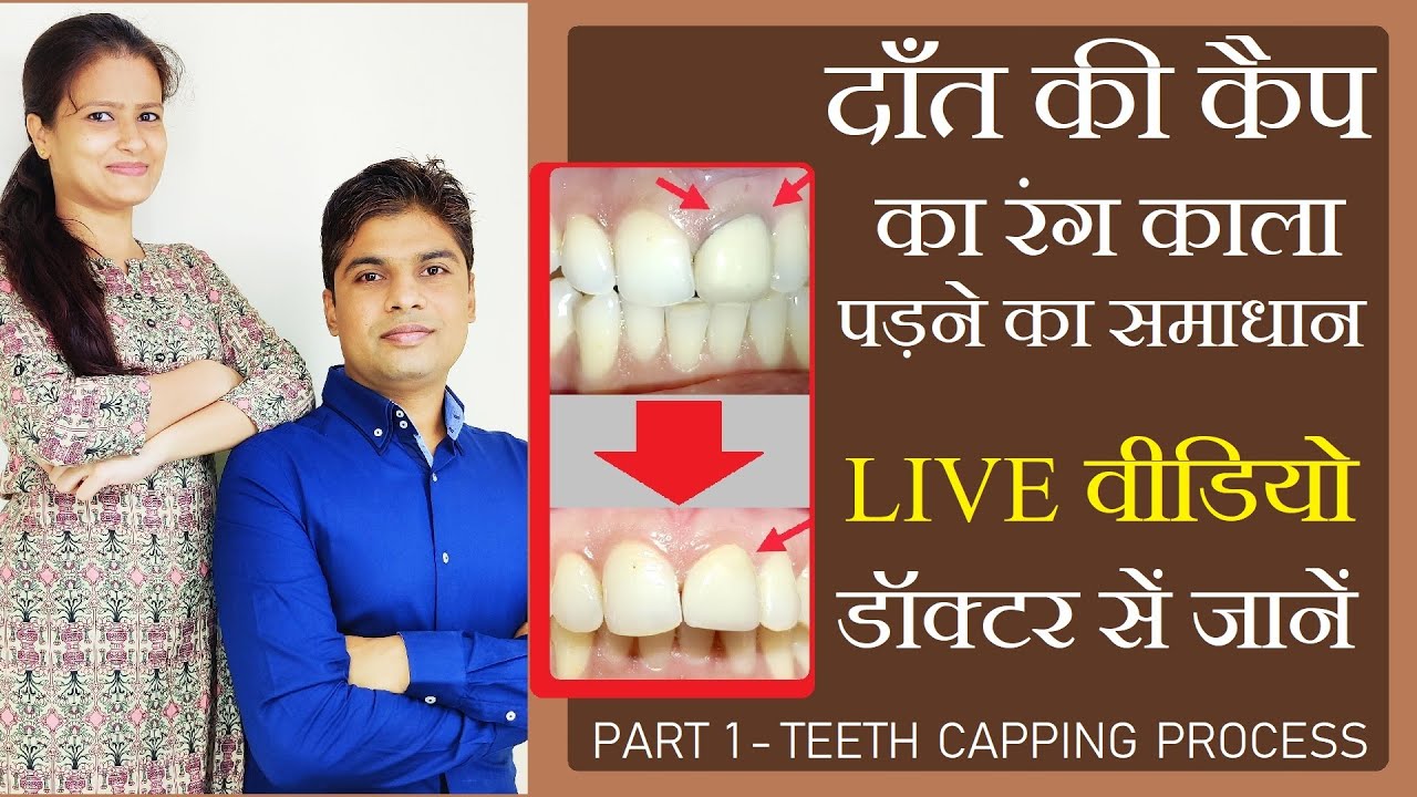 दाँतों की कैप का रंग काला पड़ने का समाधान। teeth capping process