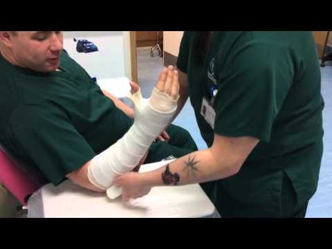 Below elbow cast using DCC