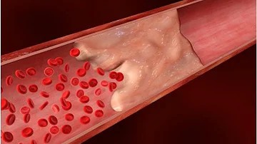 ¿Cómo puede saber si tiene calcio acumulado en las arterias?