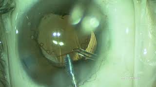 B-HEX Pupil Expander