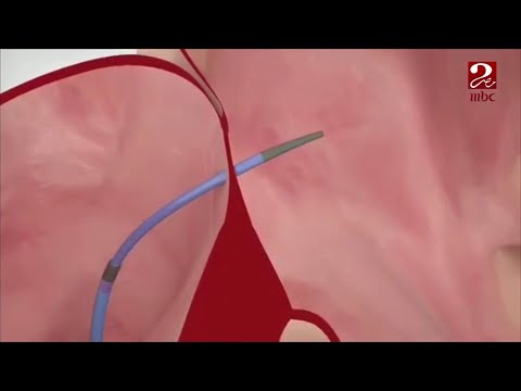 في حال فشل العلاج بالأدوية فيديو توضيحي لعلاج الارتجاف الأذيني