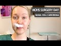 Mohs Surgery Day for Basal Cell Carcinoma