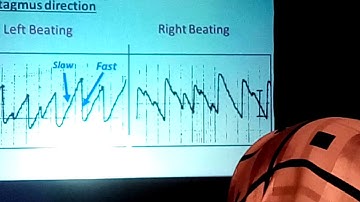 Caloric Test Procedures & Interpretation. Prof. Dr Adel Abdel Maksoud (1)