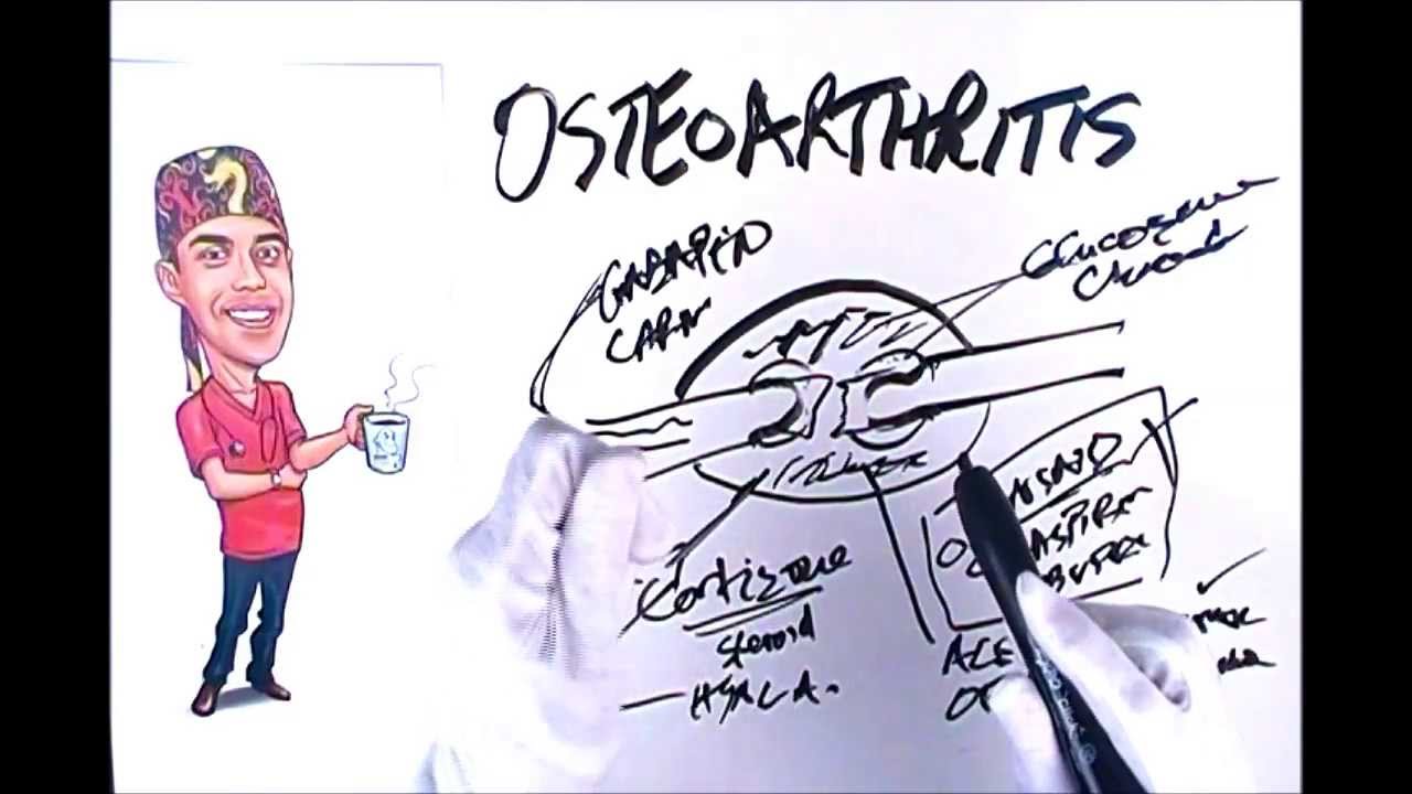 Osteoarthritis Explained Simply YouTube