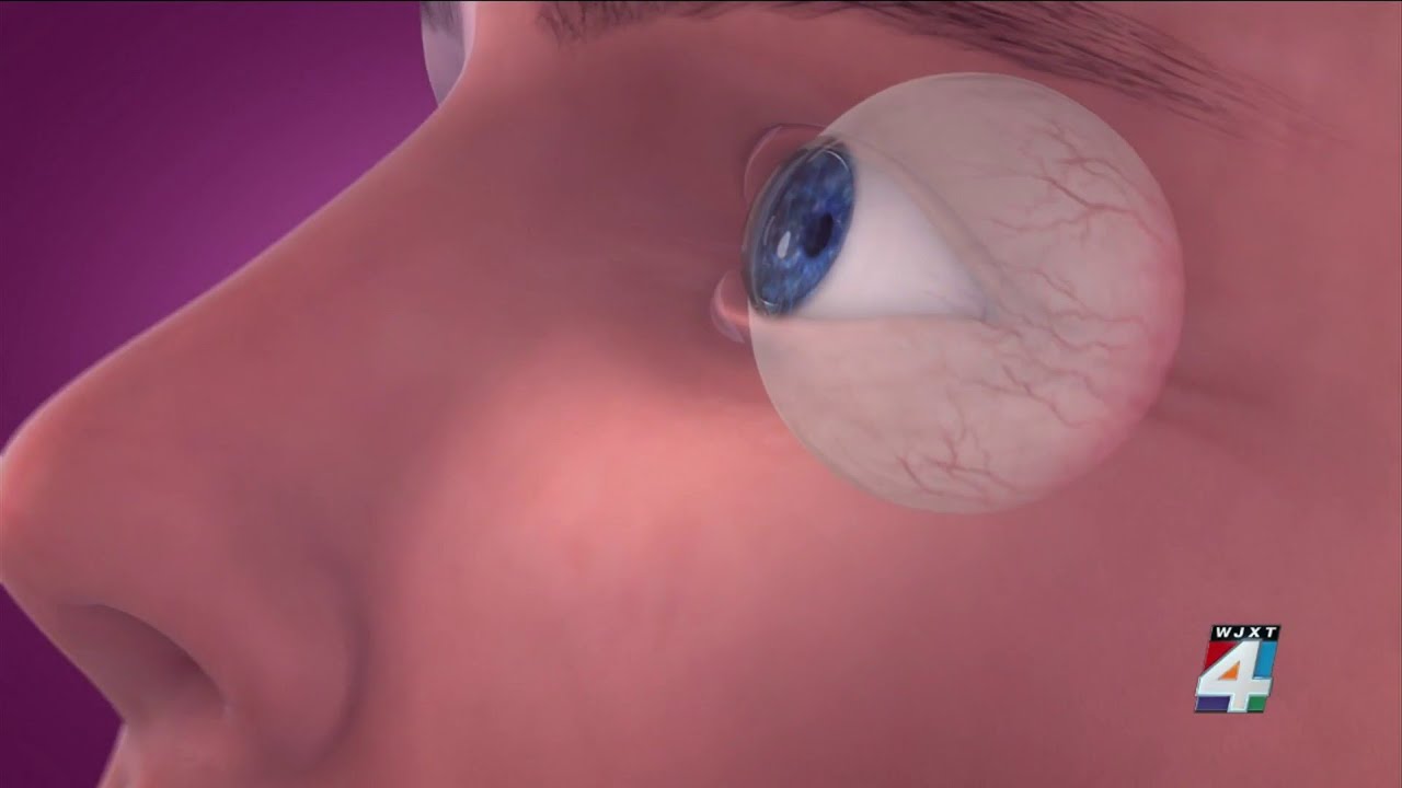 Woman’s vision improves after new procedure following cataract surgery ...