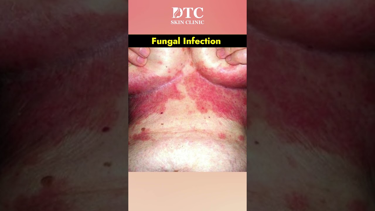 Fungal Infection Treatment | DTC Skin Clinic