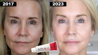 Detailed YOUNGER LOOKING SKIN AT 65? | MY 7 YEAR RETIN-A UPDATE! Details
