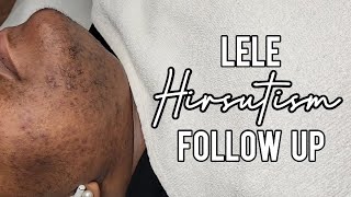 Does Waxing Make Skin Worse? You Be The Judge! Lele #Hirsutism Follow-Up