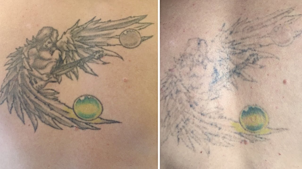 best at home tattoo removal best tattoo 2017 best at home tattoo removal best tattoo 2017