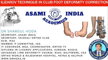 Ilizarov Technique in Clubfoot Deformity Correction - Dr Shamsul Hoda Ilizarov Lectures #clubfoot