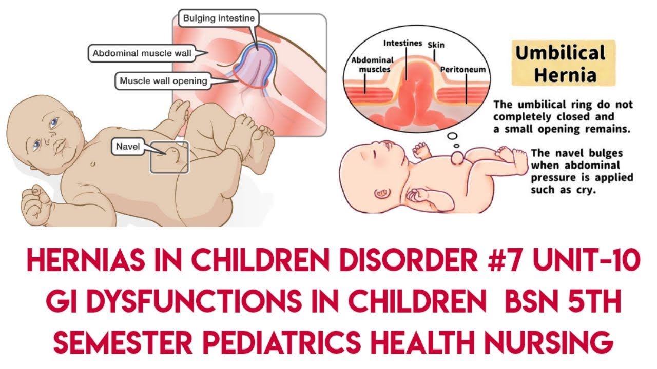 Hernias In Children || Disorder #7 ||Unit-10|| GI Dysfunction in Childrens||PHN||BSN 5th semester||
