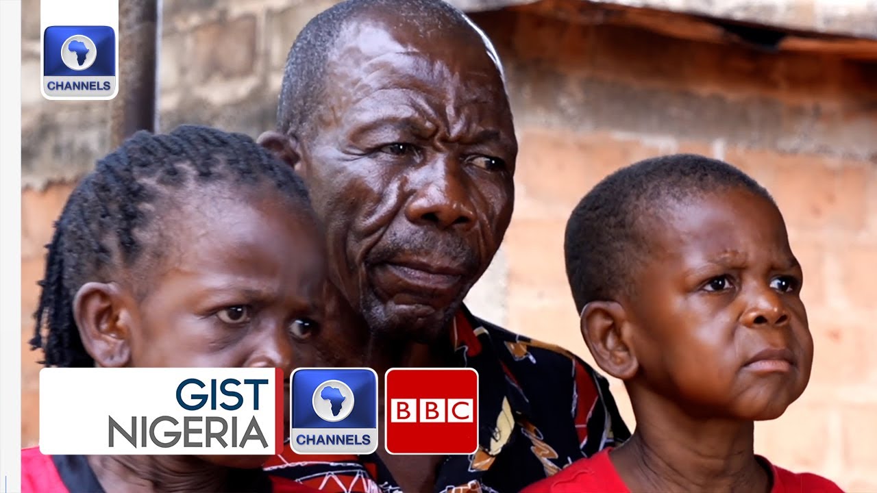 Cutis Laxa: Meet The Nigerian Family Embracing Uniqueness While Living With A Rare Disorder
