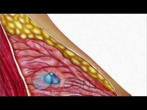 Breast Biopsy Wire Guided Surgery - PreOp Patient Education & Patient Engagement