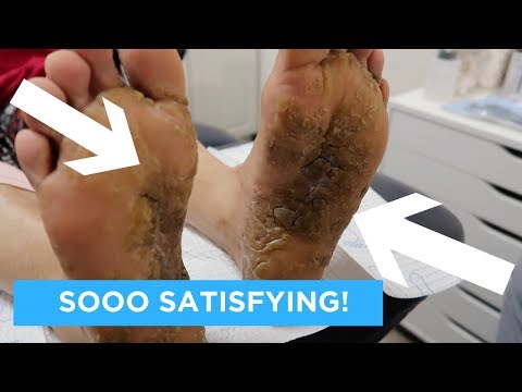 EXTREMELY SATISFYING AND RELAXING CALLUS CARE!
