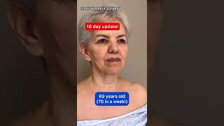 69 Year Old Facelift Patient After 10 Days