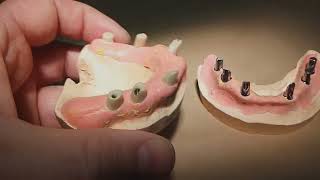 Пациентка &quot;Т&quot;. 1-я часть.&quot;2 тотала все на 6&quot; на имплантатах мегаджен.  4-я стоматология.