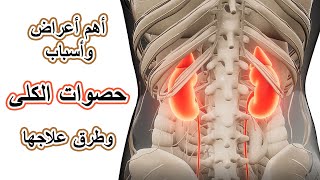 أهم  أعراض حصى الكلى، اسباب حصوات الكلى (طرق علاج حصوات الكلى)