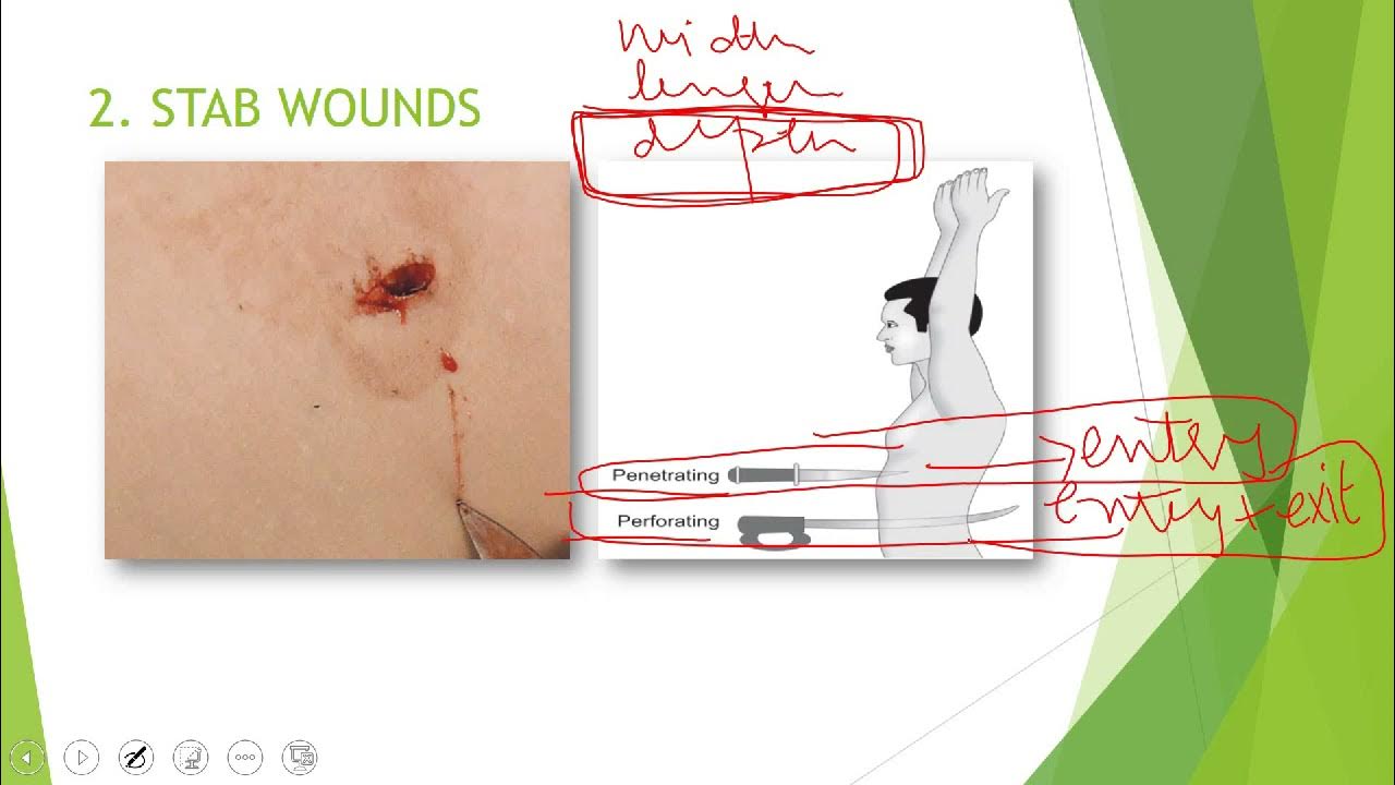 Mechanical injuries part 3of3 [sharp force traumaincised+stab+chop