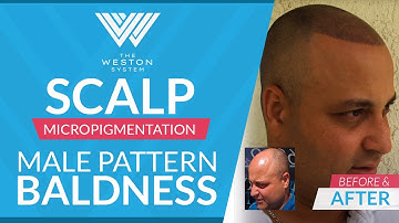 Scalp Micropigmentation Before and After - Male Pattern Baldness