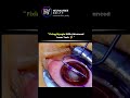 🔬 LASIK Surgery Explained | Laser Vision Tech ⚡ #Shorts