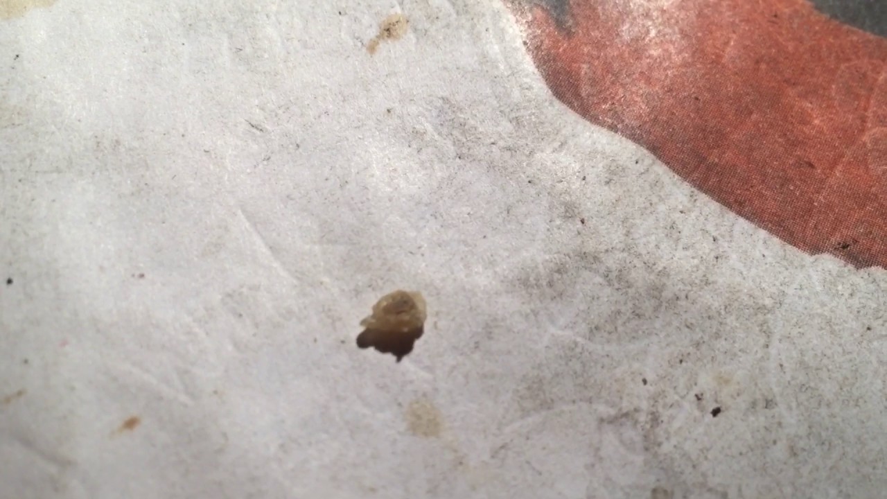 My left foot the plantar wart cut out YouTube