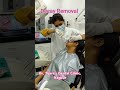 #toothdecay #compositefilling #toothcoloredfillings #cariesremoval #dentist #dentistnagpur