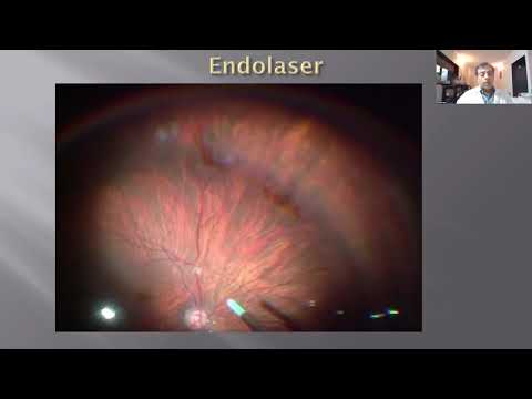 Lecture: Retinal Detachment