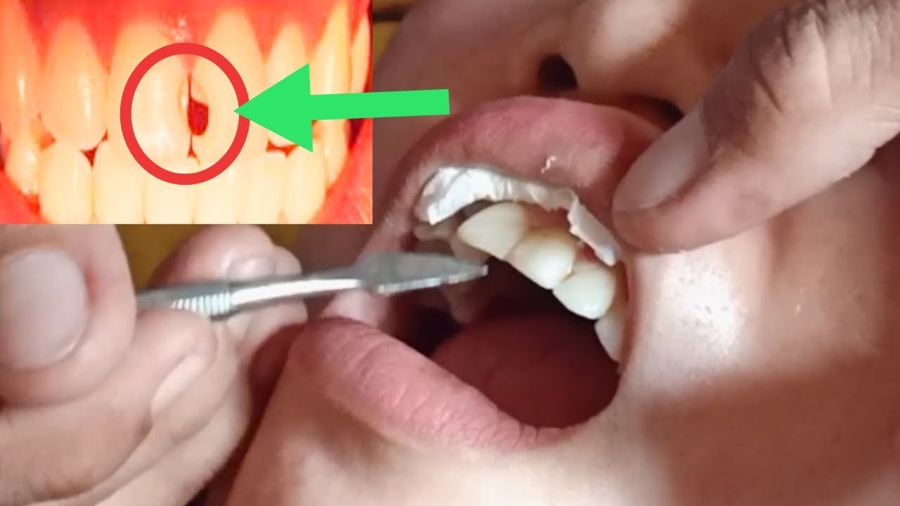 Cara Mengatasi Gigi Berlubang || Tutorial Tambal Gigi Depan