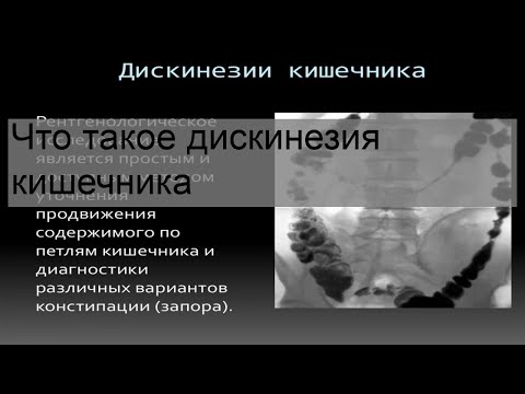 Что такое дискинезия кишечника