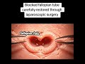 HOW TO FLUSH BLOCKED FALLOPIAN TUBES VIDEO #healtheducation #health #womenshealth