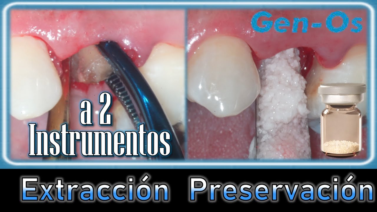 Extracción dental *a 2 instrumentos - Preservación alveolar | GEN-OS #