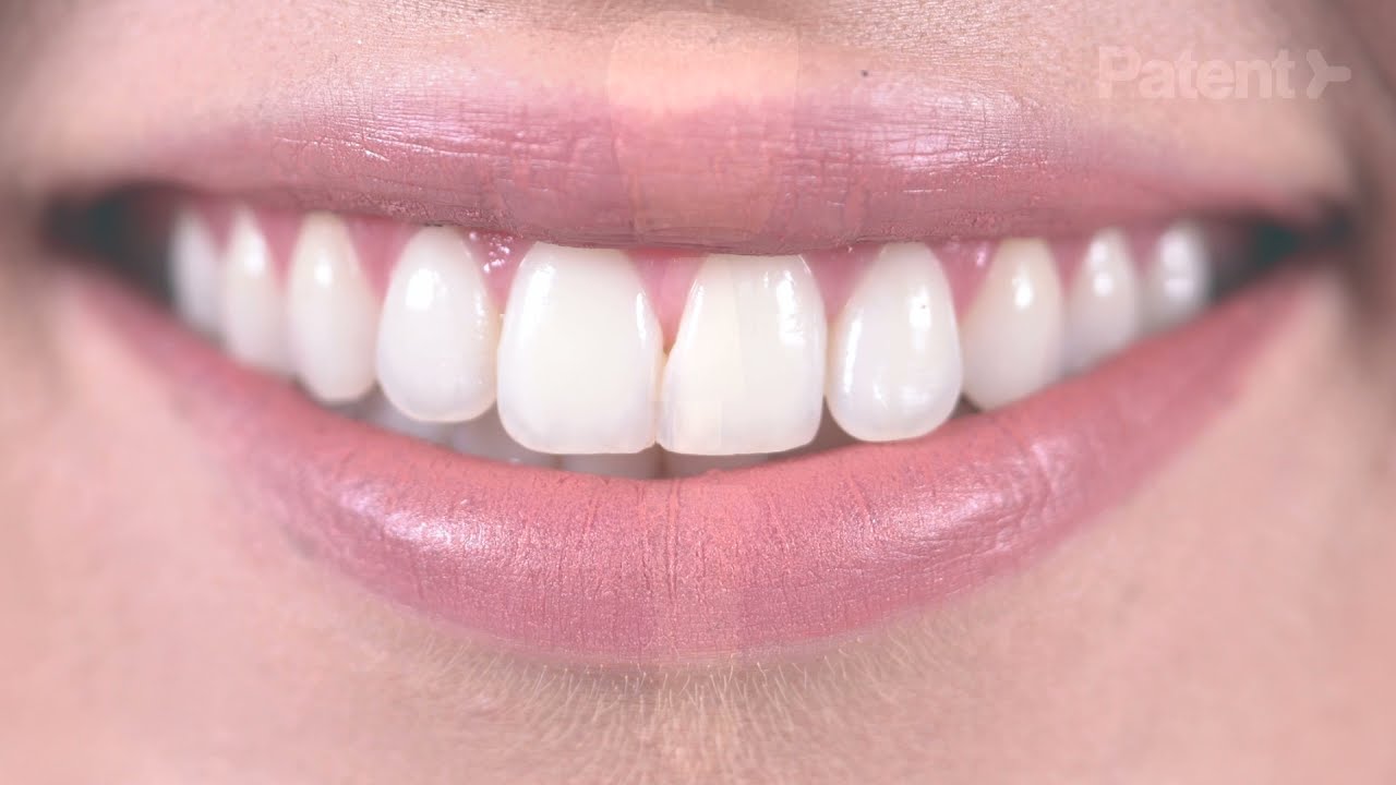 Symbionic Teeth – The Next Generation in Tooth Replacement