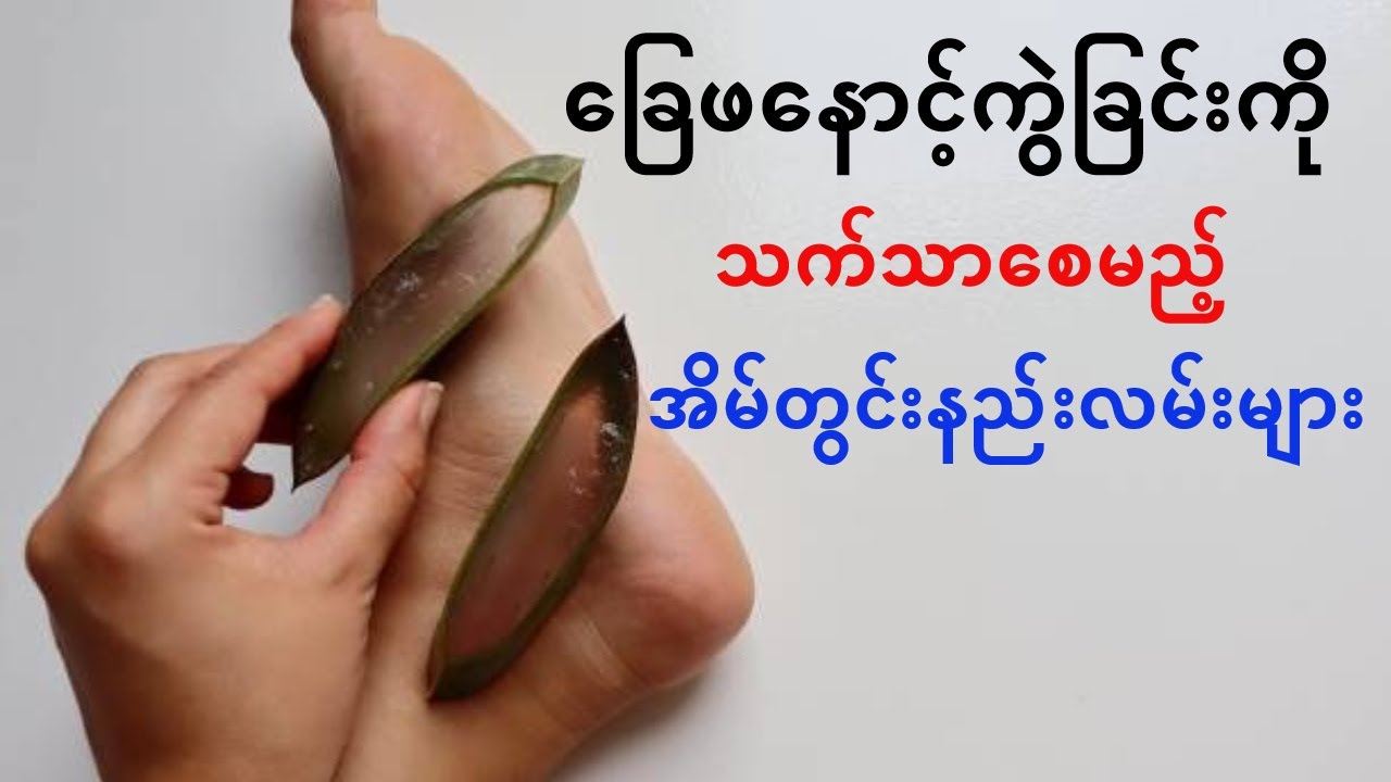 ခြေဖနောင့်ကွဲခြင်းကို သက်သာစေမည့် အိမ်တွင်းနည်းလမ်းများ
