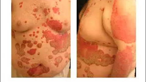 How Does Obesity Affect Psoriasis Care?