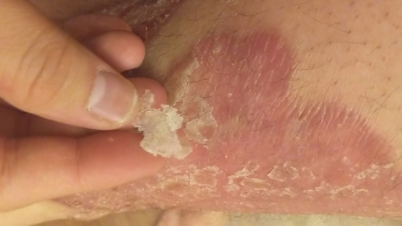 psoriasis skin peeling off)