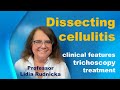 Dissecting cellulitis -  clinical features, trichoscopy, treatment