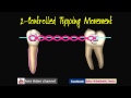 Types of Orthodontic Tooth movement