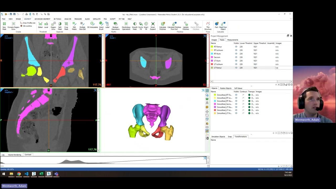 Anatomic Modeling from Segmentation to 3D Print YouTube