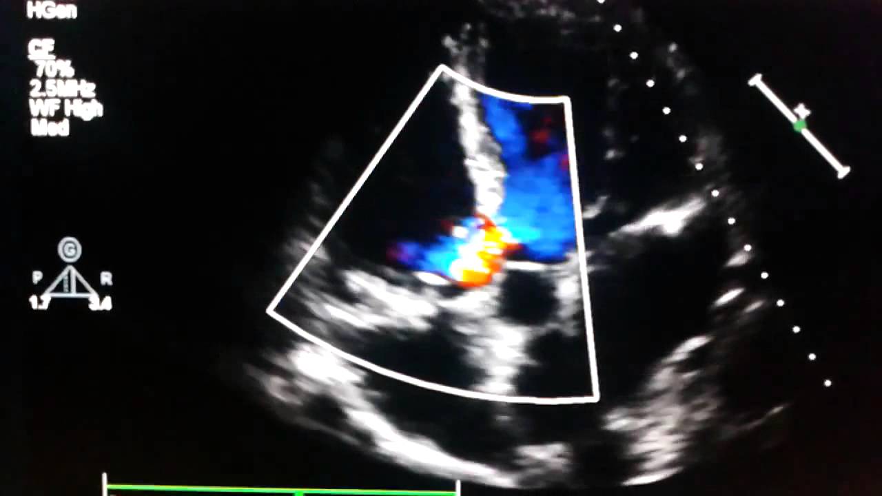 Echocardiogram - perimembranous ventricular septal defects - YouTube